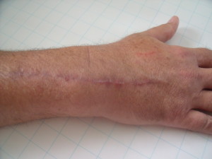 Scarring from a bike crash or car accident can be permanent unless dermabrasion, scar revision or plastic surgery options are explored